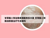 甘草酸二铵治银屑病服用多大量 甘草酸二铵肠溶胶囊治疗牛皮癣吗
