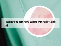 天津有牛皮癣医院吗 天津哪个医院治牛皮癖好
