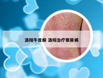 洛阳牛皮癣 洛阳治疗银屑病