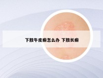 下肢牛皮癣怎么办 下肢长癣