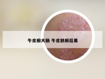 牛皮癣大肠 牛皮肤癣后果