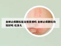 金蝉止痒颗粒能治银屑病吗 金蝉止痒颗粒功效好吗 吃多久
