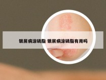 银屑病涂磷脂 银屑病涂磷脂有用吗