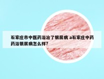 石家庄市中医药浴冶了银屑病 a石家庄中药药浴银屑病怎么样?