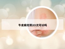 牛皮癣光照2O次可以吗