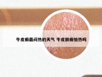 牛皮癣最闷热的天气 牛皮肤癣怕热吗