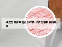 红皮型银屑病是什么样的 红皮型银屑病的症状