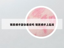 银屑病手部会暴皮吗 银屑病手上起皮