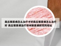 商丘银屑病怎么治疗才好商丘银屑病怎么治疗好 商丘银屑病治疗郑州银屑病研究院地址