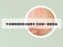 牛皮癣刺挠挠完以后疼不 牛皮癣一挠就出血
