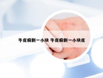牛皮癣剩一小块 牛皮癣剩一小块皮