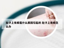肚子上有癣是什么原因引起的 肚子上有癣怎么办