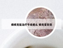 癣疾克能治疗牛皮癣么 癣克星软膏
