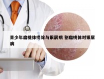 青少年扁桃体摘除与银屑病 割扁桃体对银屑病