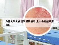 身体火气大会诱发银屑病吗 上火会引起银屑病吗