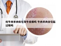 吃牛肉羊肉烩引发牛皮癣吗 牛肉羊肉会引起过敏吗