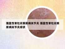 强直性脊柱炎银屑病关节炎 强直性脊柱炎银屑病关节炎症状