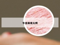 牛皮癣用火烤