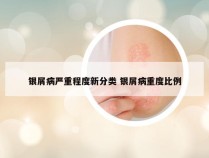 银屑病严重程度新分类 银屑病重度比例