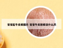 宝宝起牛皮癣图片 宝宝牛皮肤癣涂什么药