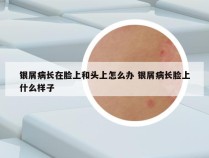 银屑病长在脸上和头上怎么办 银屑病长脸上什么样子