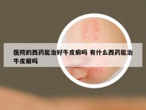 医院的西药能治好牛皮癣吗 有什么西药能治牛皮廨吗