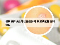 银屑病藓块处可以直接刮吗 银屑病能把皮剥掉吗