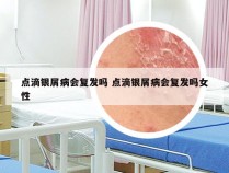 点滴银屑病会复发吗 点滴银屑病会复发吗女性