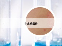 牛皮癣最终