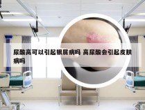 尿酸高可以引起银屑病吗 高尿酸会引起皮肤病吗