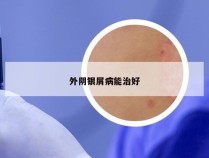 外阴银屑病能治好