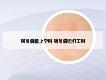 银屑病能上学吗 银屑病能打工吗