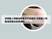 甘草酸二铵肠溶胶囊治牛皮癣吗 甘草酸二铵肠溶胶囊治皮肤病吗
