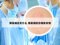 银屑病忌食什么 银屑病禁忌哪些食物