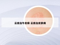 云南治牛皮癣 云南治皮肤病
