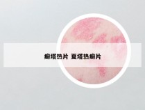 癣塔热片 夏塔热癣片