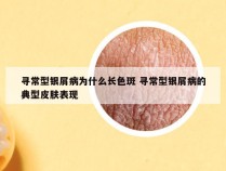 寻常型银屑病为什么长色斑 寻常型银屑病的典型皮肤表现