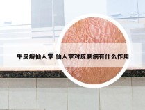 牛皮癣仙人掌 仙人掌对皮肤病有什么作用