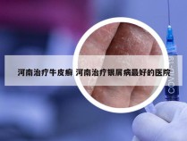 河南治疗牛皮癣 河南治疗银屑病最好的医院