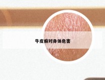 牛皮癣对身体危害