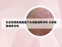 头皮型银屑病是整个头皮都增厚冯吗 头皮银屑病常见吗