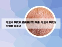 阿达木单抗银屑病就好出效果 阿达木单抗治疗银屑病用法