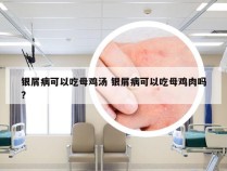 银屑病可以吃母鸡汤 银屑病可以吃母鸡肉吗?
