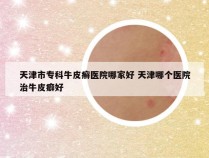天津市专科牛皮癣医院哪家好 天津哪个医院治牛皮癖好