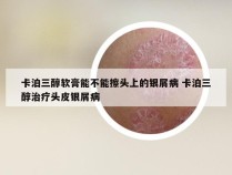 卡泊三醇软膏能不能擦头上的银屑病 卡泊三醇治疗头皮银屑病