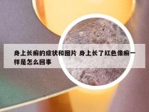 身上长癣的症状和图片 身上长了红色像癣一样是怎么回事