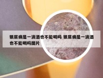 银屑病是一滴酒也不能喝吗 银屑病是一滴酒也不能喝吗图片