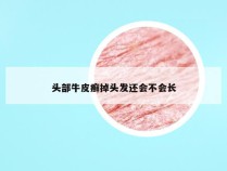 头部牛皮癣掉头发还会不会长