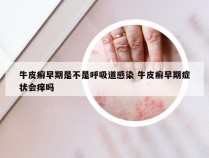 牛皮癣早期是不是呼吸道感染 牛皮癣早期症状会痒吗