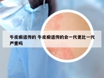 牛皮癣遗传的 牛皮癣遗传的会一代更比一代严重吗